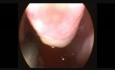Removal of Antrochoanal Polyp by Shaver