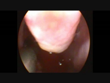 Removal of Antrochoanal Polyp by Shaver