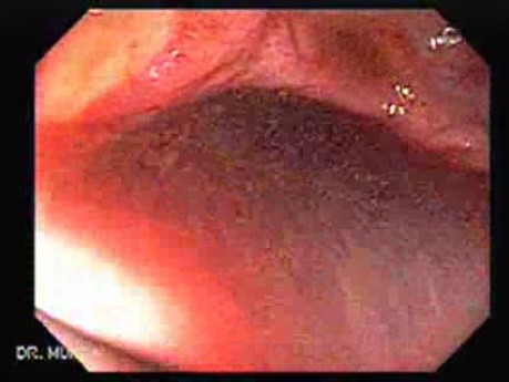 Massive Rectal Bleeding (3 of 11)