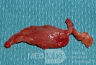 Large Stalked Polyp Arising From Uncinate Process