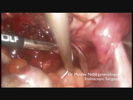 How to Make Simple Complex Myomectomy