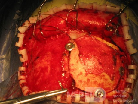 Craniotomy Tools and Procedures
