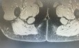 MRI of Anal Fistula Associated with a Submucosal Abscess