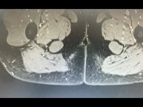 MRI of Anal Fistula Associated with a Submucosal Abscess