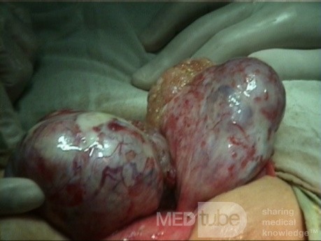 Cancer Ovary