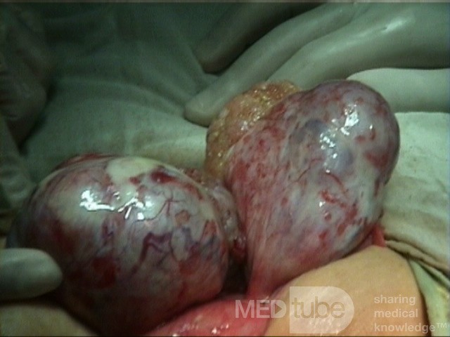 Cancer Ovary