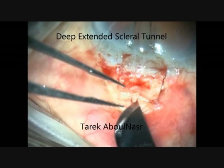 Modified Trabeculectomy (Deep Extended Scleral Tunnel DEST)