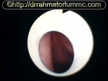 The View of True Vocal Folds Vibrations Through T Tube