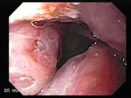 Enlarged tonsils - endoscopic view 1/2