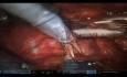 Robot Assisted Partial Nephrectomy in a Horseshoe Kidney