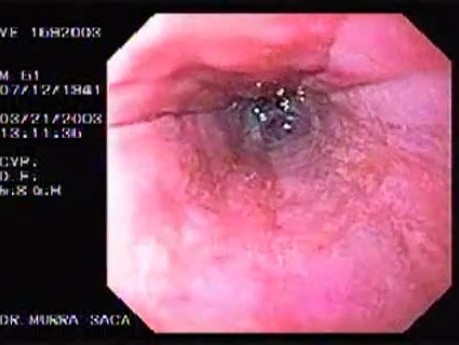 Banding of esophageal varices (9 of 17)