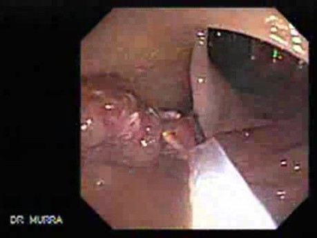 Stalked Polyp - Polypectomy (4 of 6)