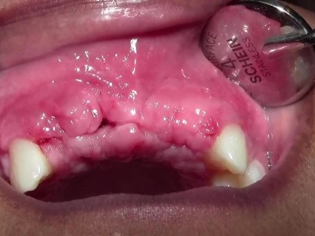 Bone Grafting #7-8-X-10 Sites - 2 Week p-o