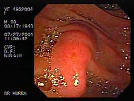 Chronic Gastritis (8 of 8)