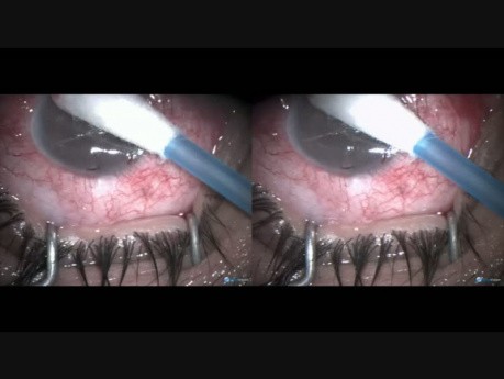 Angle Recession Glaucoma - New Microtrack Operation