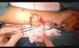 Excision of a Schwannoma Tumor