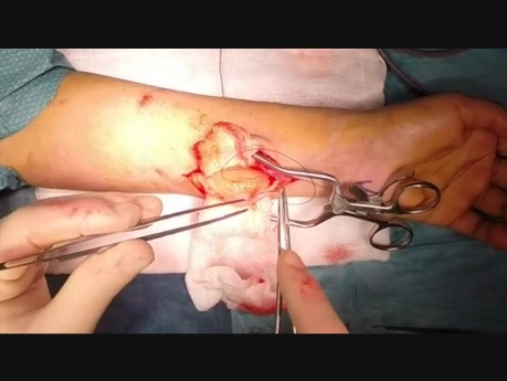 Excision of a Schwannoma Tumor