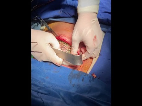 Chest Wall Reconstruction with Plate and Screw