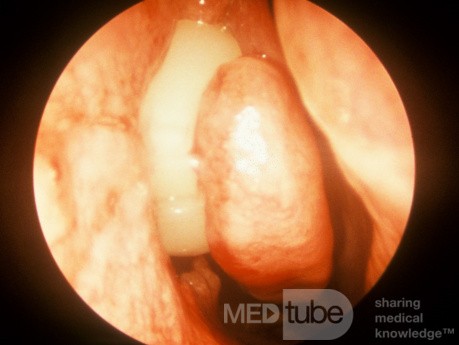 Early Orbital Cellulitis Intraoperative View [right]