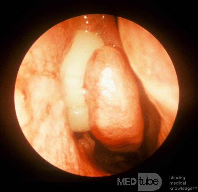 Early Orbital Cellulitis Intraoperative View [right]