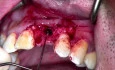 Anterior Bone Level Tapered (BLT) Implant with Bone Augmentation