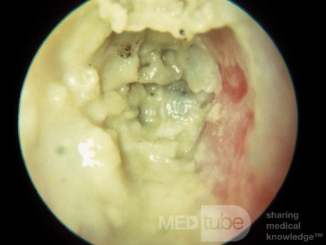 Otomycosis Typical Appearance