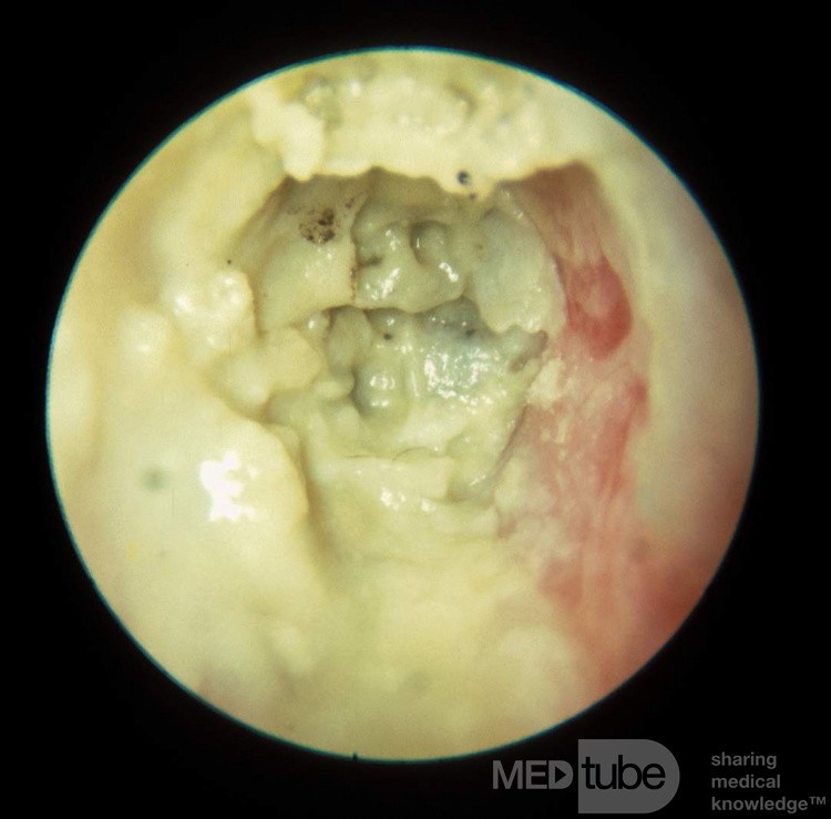 Otomycosis Typical Appearance