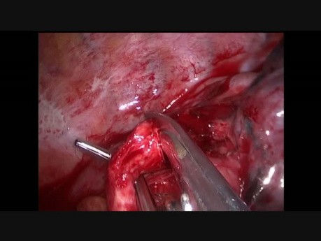 Uniportal VATS Right Lower Sleeve Lobectomy