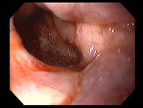 Massive Epistaxis - Final Alcohol Ablation Status - 6/8
