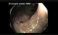 Colonoscopy Channel - Follow-up After EMR of LST-NG Tumor
