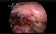Laparoscopic Repair of Iaitrogenic Colonoscopic Perforation