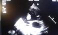 Huge Thrombus in Left Ventricle