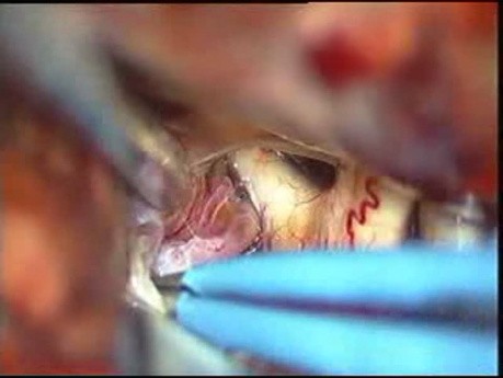  Brain aneurysm - Anterior Communicating Artery Aneurysm - Microsurgical clipping