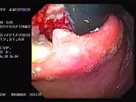Gastric Carcinoma - Argon Plasma Coagulation (APC) Treatment (1 of 8)