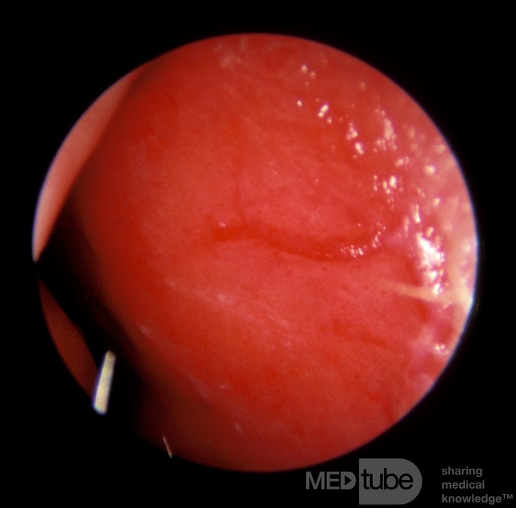 Kiesselbach's Plexus