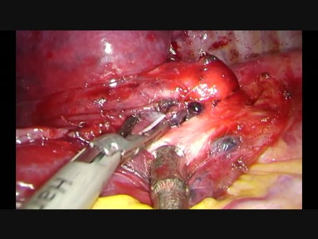 Situs Inversus Uniportal VATS Anatomic Segmentectomy S1-2 and S6