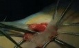 PHS - inguinal hernia repair