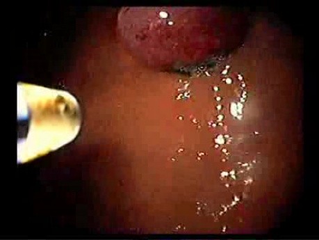 Endoscopy of Mallory Weiss Tear - Assessment of Treatment Results