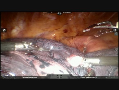 Left Bronchus Carcino Sarcoma