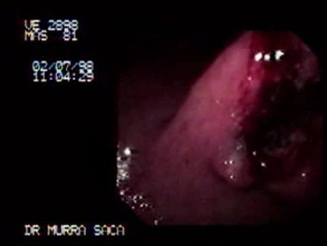 Gastric Adenocarcinoma - Obstruction 1