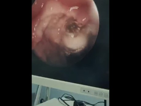 Endoscopic Coblation Assisted Adenoidectomy