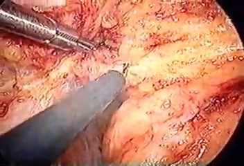 Laparoscopic abdominoperineal resection