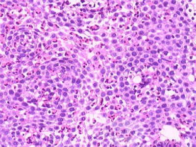 Eosinophilic Esophagitis (6 of 6)