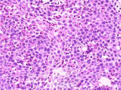 Eosinophilic Esophagitis (6 of 6)