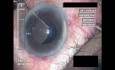 Cataract Surgery XI - Part 4