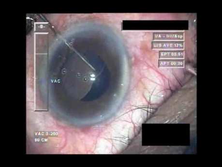 Cataract Surgery XI - Part 4