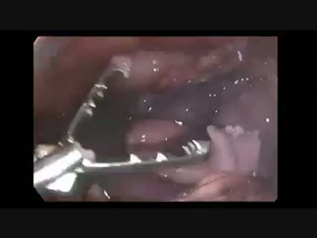 Noncommunicating Rudimentary Horn Pregnancy