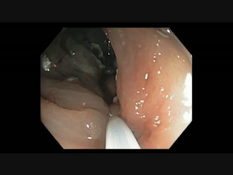Colonoscopy - Hepatic Flexure - Flat Lesion - Piecemeal EMR & Avulsion
