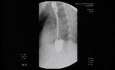 Esophageal Achalasia - Extreme Narrowing of the Esophago-gastric Junction