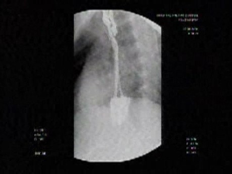 Esophageal Achalasia - Extreme Narrowing of the Esophago-gastric Junction